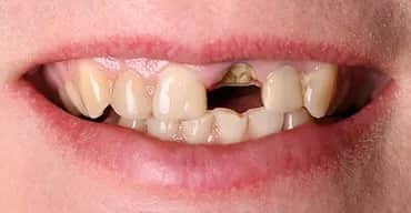 Ile kosztuje odbudowa złamanego zęba? Poznaj ceny i metody